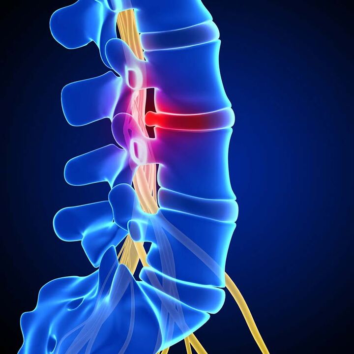 fájdalomcsillapítás az ágyéki gerinc osteochondrosisában)
